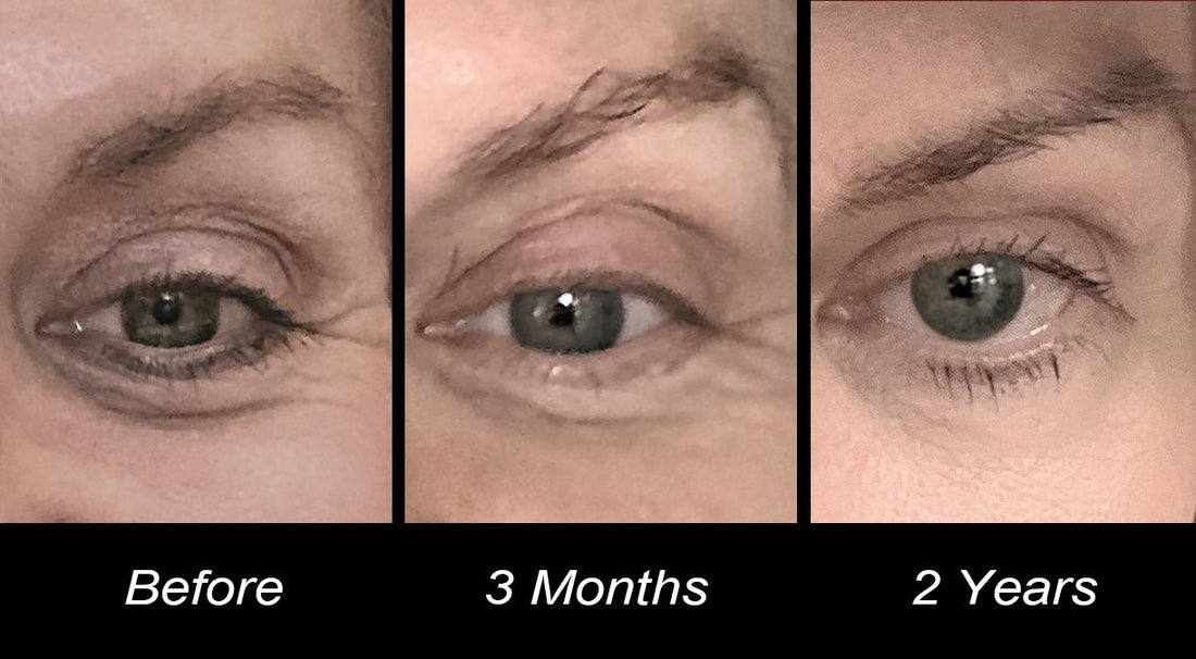 Why You Need A Pro-Aging Eye Cream - Vitali Skincare